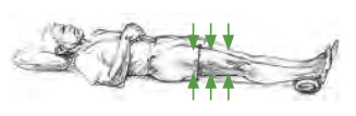 Quadriceps Sets